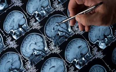 Common Neurological Disorders Affecting Speech